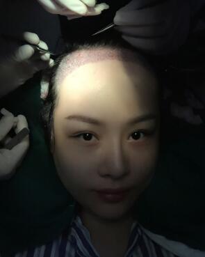 植發(fā)手術(shù),將健康毛發(fā)組織移植到前額