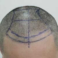 北京微創(chuàng)植發(fā)價(jià)格23800元，植發(fā)過程多圖對(duì)比分享