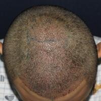 北京微創(chuàng)植發(fā)價(jià)格23800元，植發(fā)過程多圖對(duì)比分享