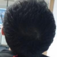 北京微創(chuàng)植發(fā)價(jià)格23800元，植發(fā)過程多圖對(duì)比分享