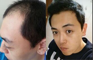 植發(fā)前后對比圖