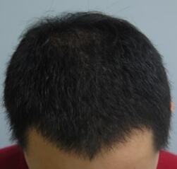 植發(fā)4個月了，期間有正常脫發(fā)