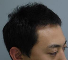 植發(fā)半年了，頭發(fā)沒有再掉落的情況，用手扒扯了一下，長的很牢固