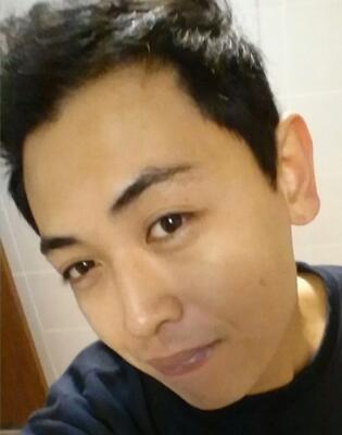 植發(fā)一年了