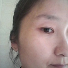 真人記錄了彩光嫩膚前后過程，果真的還不錯