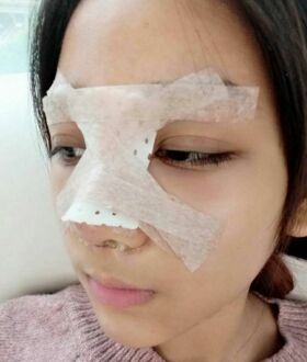 隆鼻整形日記，像變了個人似的