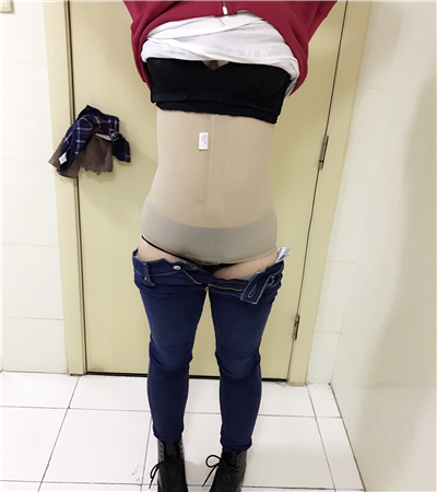 分享我的吸脂瘦腰腹手術(shù)經(jīng)歷，還有前后的照片哦~