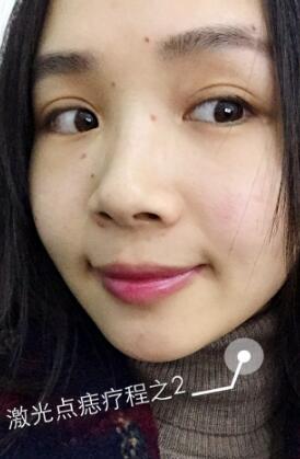 激光去痣果分享