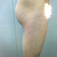 大腿抽脂瘦大腿恢復(fù)全過(guò)程我也有纖細(xì)的美腿了