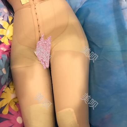 大腿抽脂瘦大腿恢復(fù)全過(guò)程我也有纖細(xì)的美腿了