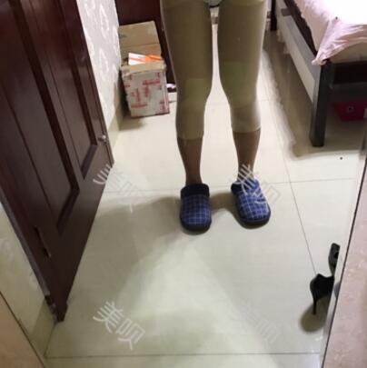 大腿抽脂瘦大腿恢復(fù)全過(guò)程我也有纖細(xì)的美腿了
