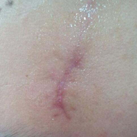 分享下我的手術(shù)切除祛疤過程路給大家做個(gè)參考