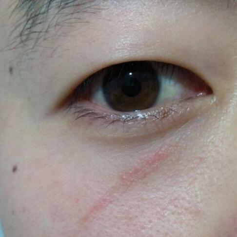 分享下我的手術(shù)切除祛疤過程路給大家做個(gè)參考