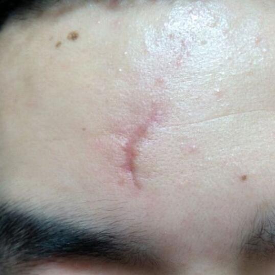 分享下我的手術(shù)切除祛疤過程路給大家做個(gè)參考