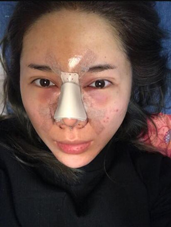 我的隆鼻整形加玻尿酸豐額頭以及B****的真實(shí)經(jīng)歷