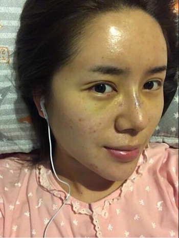 我的隆鼻整形加玻尿酸豐額頭以及B****的真實(shí)經(jīng)歷