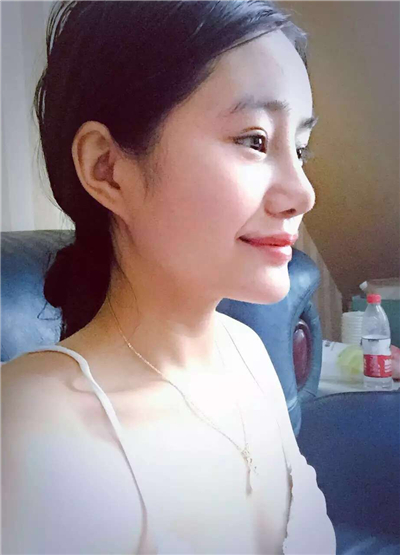 我做自體脂肪隆鼻手術(shù)恢復(fù)過(guò)程和前后對(duì)比果圖片分享哦~