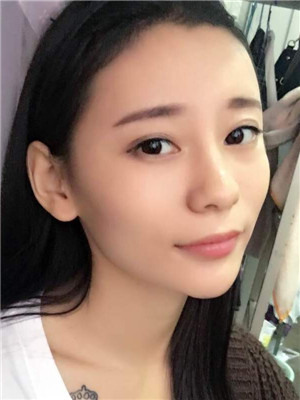 做了全臉自體脂肪填充你們覺得好看嗎