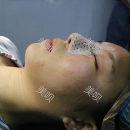 硅膠假體隆鼻+耳軟骨墊鼻尖大家看看果還不錯(cuò)吧