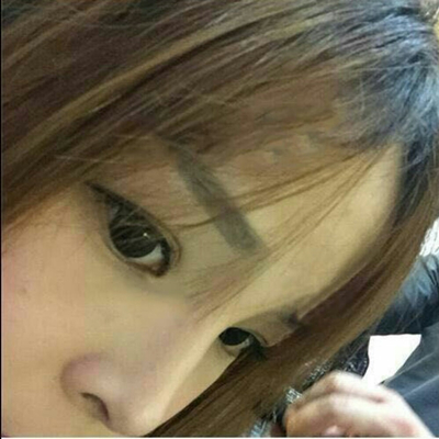 玻尿酸注射隆鼻三個月了，分享術(shù)后恢復(fù)照片哇~