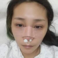 做鼻部綜合整形真是一件正確的決定，鼻子恢復(fù)過程分享