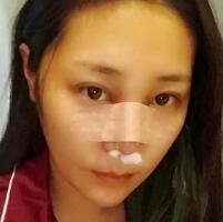 做鼻部綜合整形真是一件正確的決定，鼻子恢復(fù)過程分享