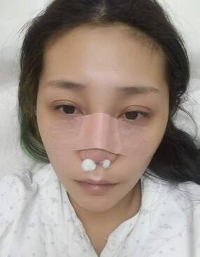 鼻部綜合整形手術(shù)