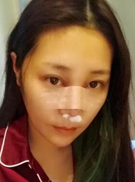 隆鼻整形手術(shù)第二天的照片