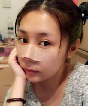 已經(jīng)隆鼻整形第五天