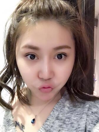 鼻子整形2個(gè)多月了，差不多基本恢復(fù)了，可以任意揉捏