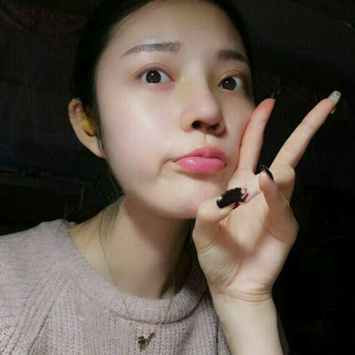 做了隆鼻整形手術(shù)好看多了，分享前后對比果照片~