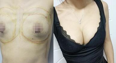 隆胸恢復(fù)過程和隆胸前后對比照片