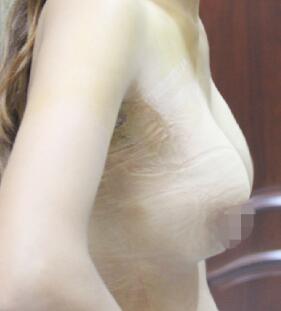 假體隆胸術(shù)后一周，拆完線