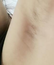 假體隆胸快術(shù)后兩個月了，腋下傷口已經(jīng)完全愈合
