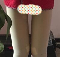 今年去做了大腿吸脂減肥手術(shù)，吸脂果挺好的