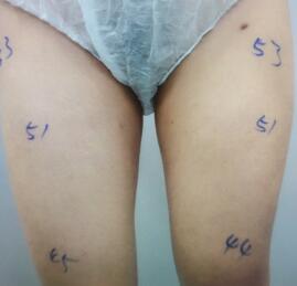 吸脂減肥瘦大腿