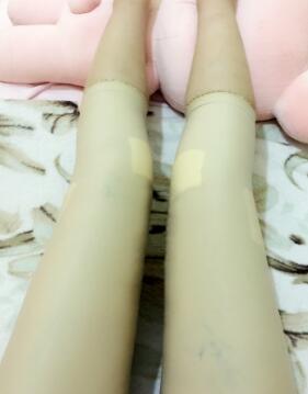 吸脂減肥瘦大腿第8天了，今天去拆線