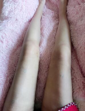 大腿吸脂手術(shù)后一直沒有洗腿，不敢洗，怕傷口感染