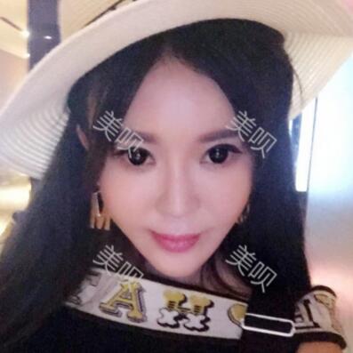 自體脂肪全臉填充讓我變得年輕漂亮了