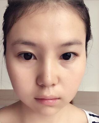 做隆鼻整形的親身日記，氣質(zhì)完全不一樣了