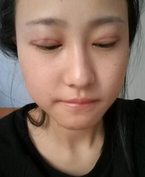 割雙眼皮整形恢復(fù)過(guò)程分享