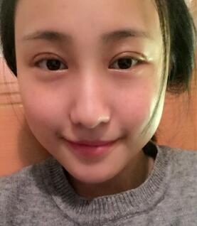 雙眼皮恢復(fù)的很好
