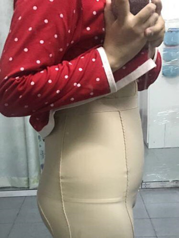 我的腰腹部吸脂減肥真實案例