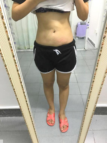 我的腰腹部吸脂減肥真實案例