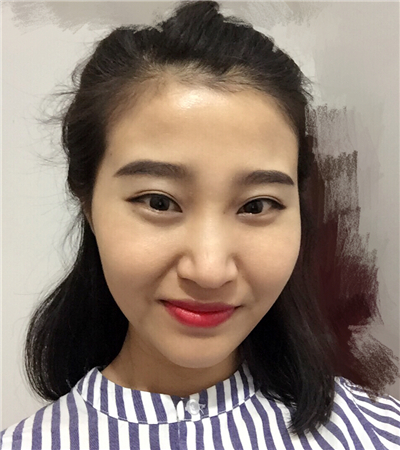 玻尿酸注射隆鼻前后對(duì)比果圖片分享，大同美神賈文醫(yī)生做的~