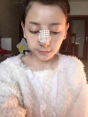 自體軟骨隆鼻手術(shù)前后過程以及對(duì)比照片分享