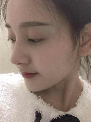 自體軟骨隆鼻手術(shù)前后過程以及對(duì)比照片分享