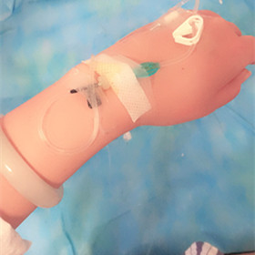 大腿抽脂手術(shù)后，還我小細(xì)腿!還有對(duì)比照片喲!