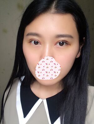 雙眼皮失敗修復(fù)手術(shù)恢復(fù)超自然，看起來(lái)一點(diǎn)都不假