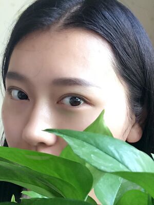 雙眼皮失敗修復(fù)手術(shù)恢復(fù)超自然，看起來(lái)一點(diǎn)都不假